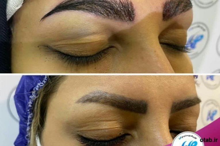 کاشت ابرو مناسب افرادی که ابروهای کم پشتی دارند