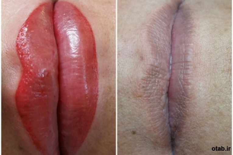 :: میکروبلیدینگ میکروپیگمنتیشن طراحی ابرو تاتو ابرو فیبروز ابرو کاشت مژه کاشت ناخن
