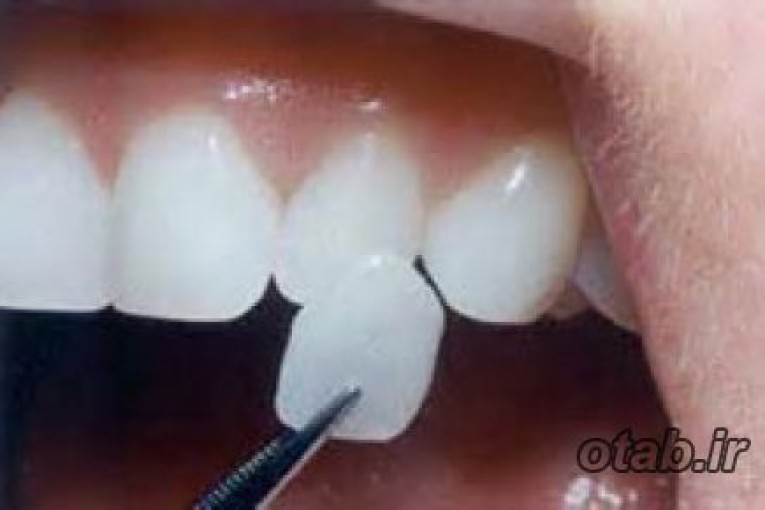 مزايا و معايب روش هاي مختلف سفيد کردن دندان
